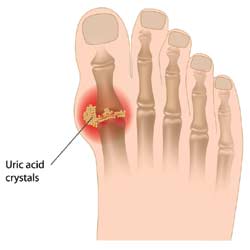 gout-arthritis podagra 4
