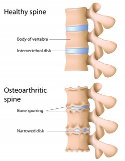 spondylosis 4