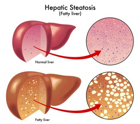 fatty liver 4 4 4