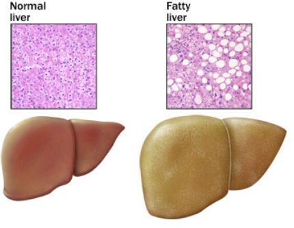 fatty liver 4 froustozh