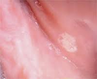 leukoplakia 4