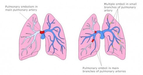 pneumonikh embollh 4