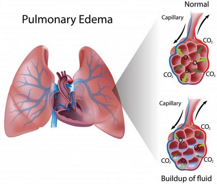 pneumoniko oidhma 4