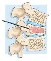 spondyloplastikh 4 kyphoplastikh