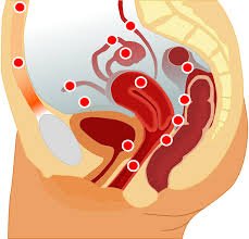 endometriosis 4 4