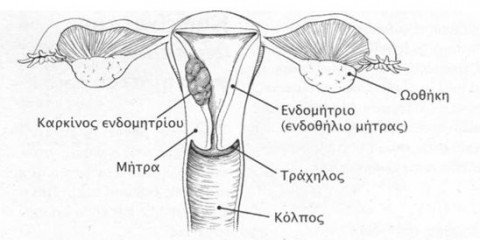 karkinos endomhtriou555