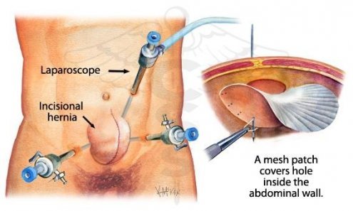 hernia_su555555rgery2