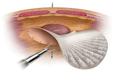 lap-incis555ional-hernia