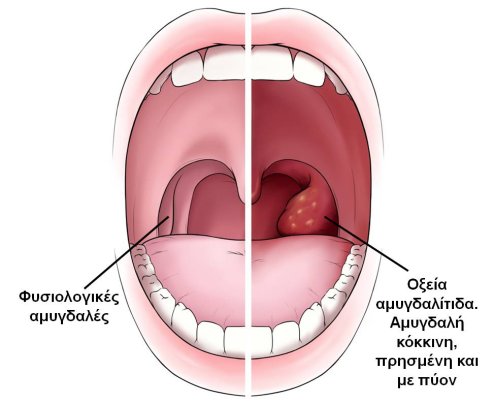 amygdalitida5