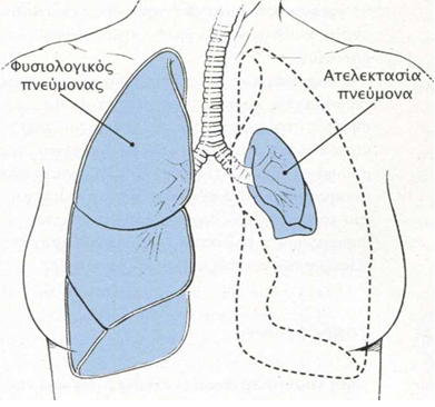 atelektasia 5