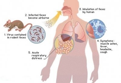 hantavirus-trans555555555mission-52d678d7