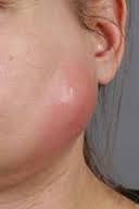 imaparotitis5555ges