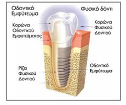 implants5