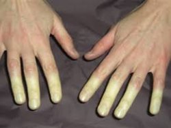 raynaud fainomeno5