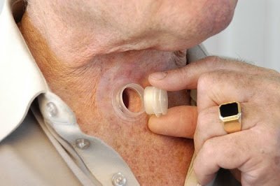 Josif inserting