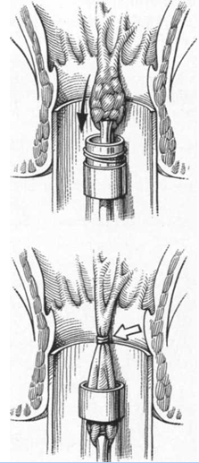 aimorroides 5