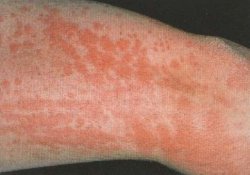 derma4