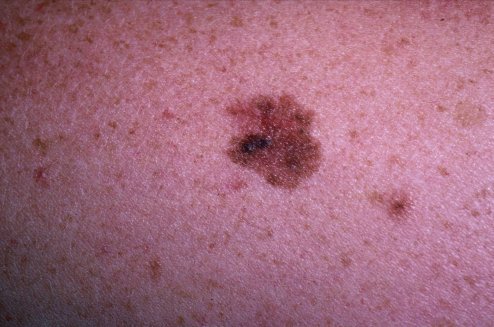 melanoma5