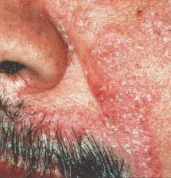 seborrheic dermatitis5