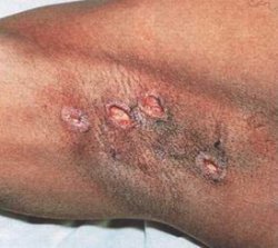 ekthyma