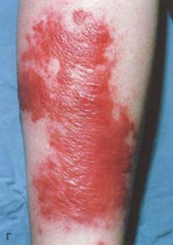 erysipelas 3
