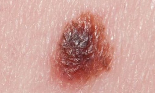 melanoma