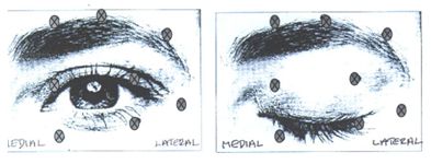 botox-diplopia