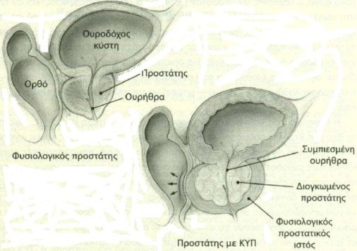 yperplasia-prostati