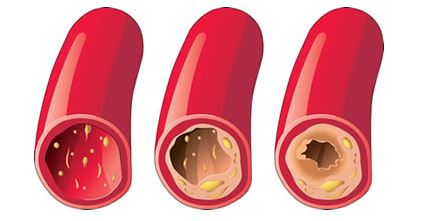 Αθηροσκλήρωση και συμπτώματα