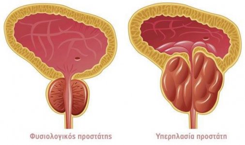 Ureablasm mint a prosztatitis oka